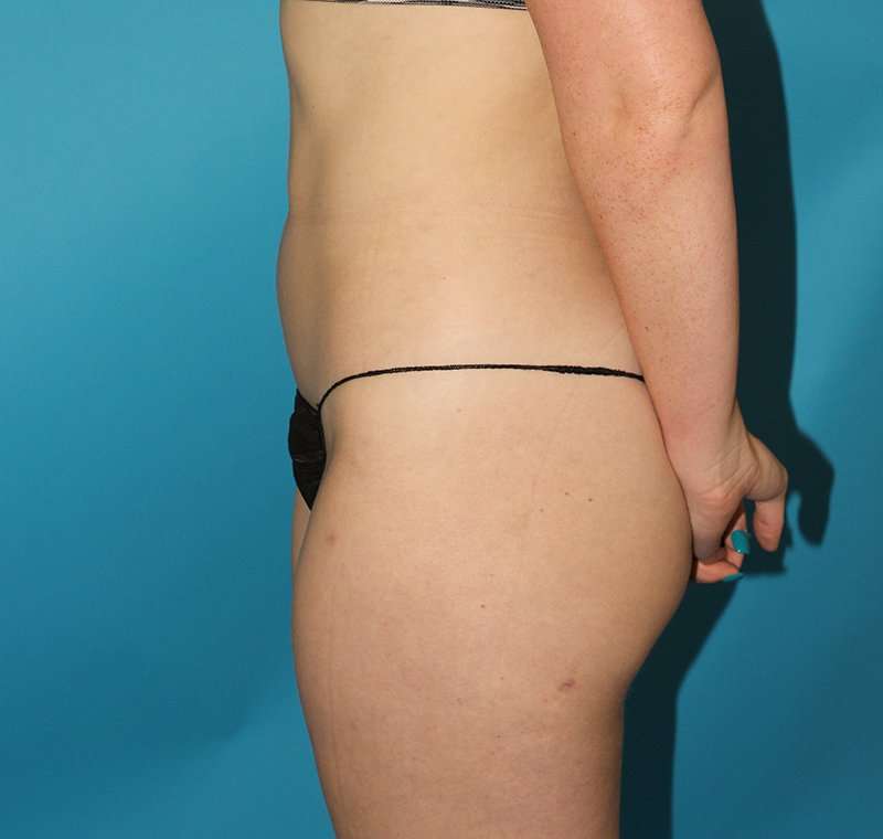 Liposuction Before & After Patient #1281
