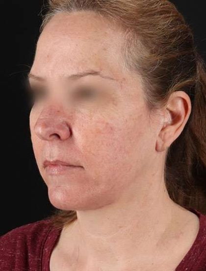 Neck Lift Before & After Patient #6838