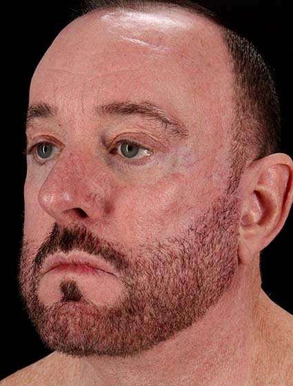 Neck Lift Before & After Patient #6856