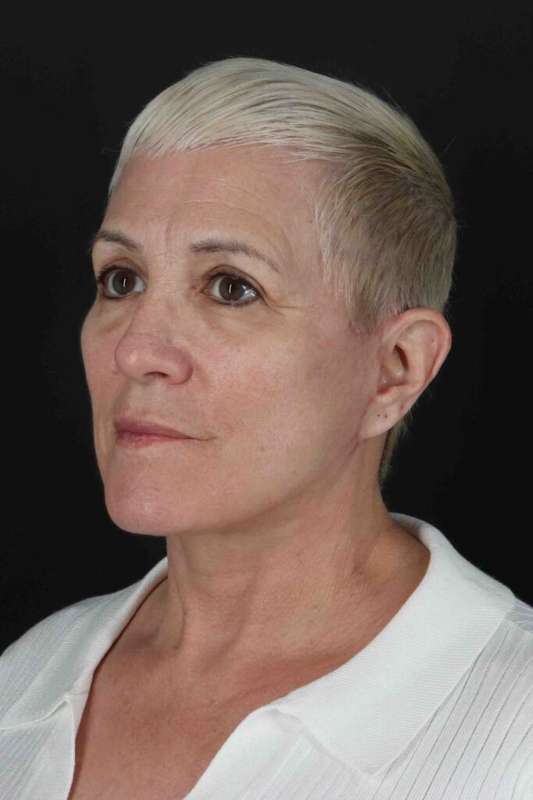 Neck Lift Before & After Patient #6909