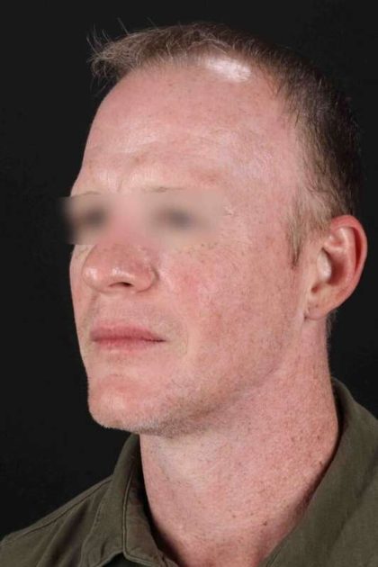 CO2 Laser Before & After Patient #6931