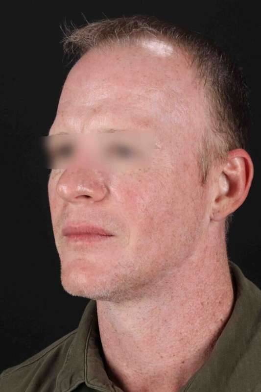 CO2 Laser Before & After Patient #6931