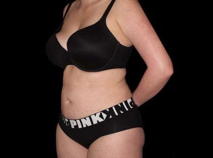 Liposuction Before & After Patient #1298
