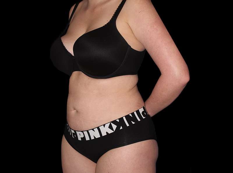Liposuction Before & After Patient #1298