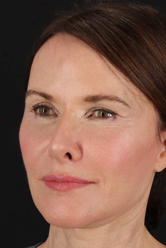 CO2 Laser Before & After Patient #6975