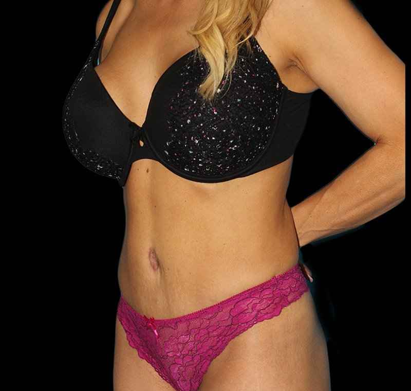 Liposuction Before & After Patient #1310