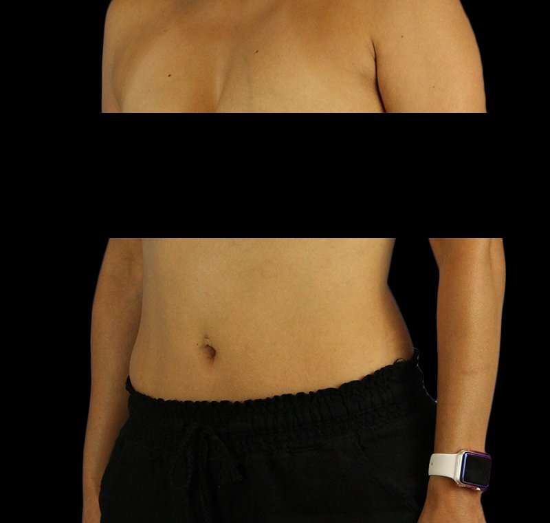 Liposuction Before & After Patient #1332