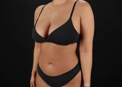 Liposuction Before & After Patient #1469
