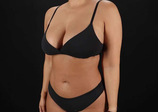 Liposuction Before & After Patient #1469