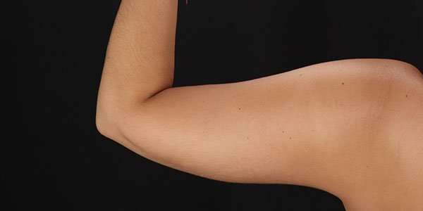 Liposuction Before & After Patient #1482