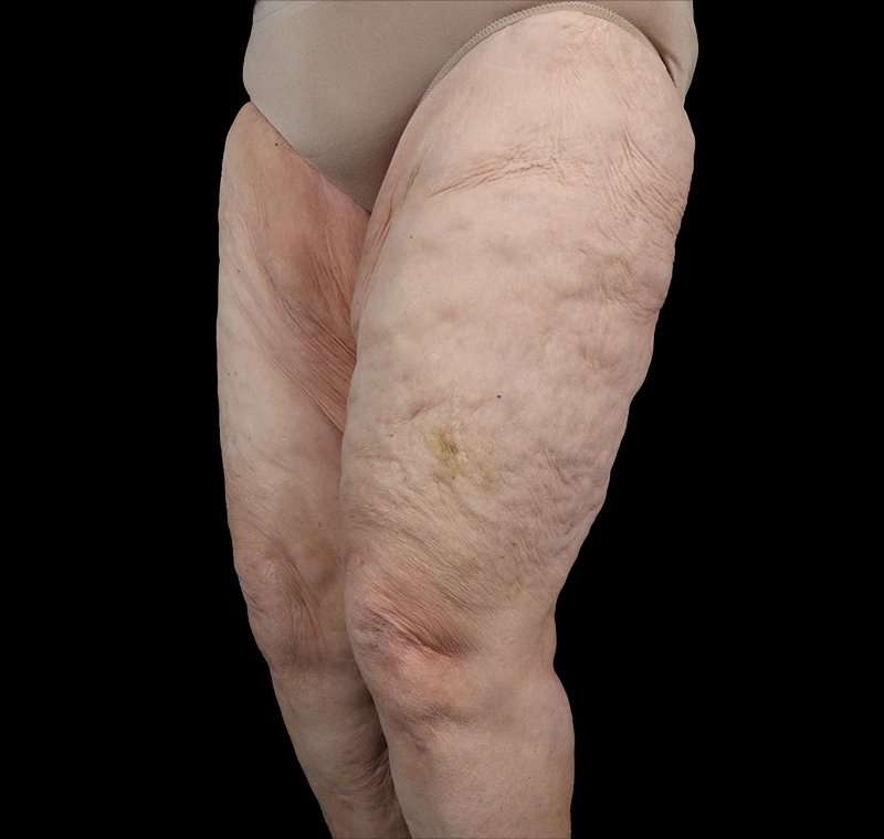 Liposuction Before & After Patient #1495