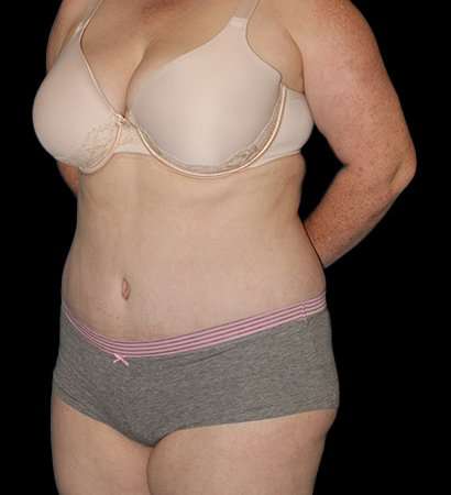 Abdominoplasty (Tummy Tuck) Before & After Patient #625