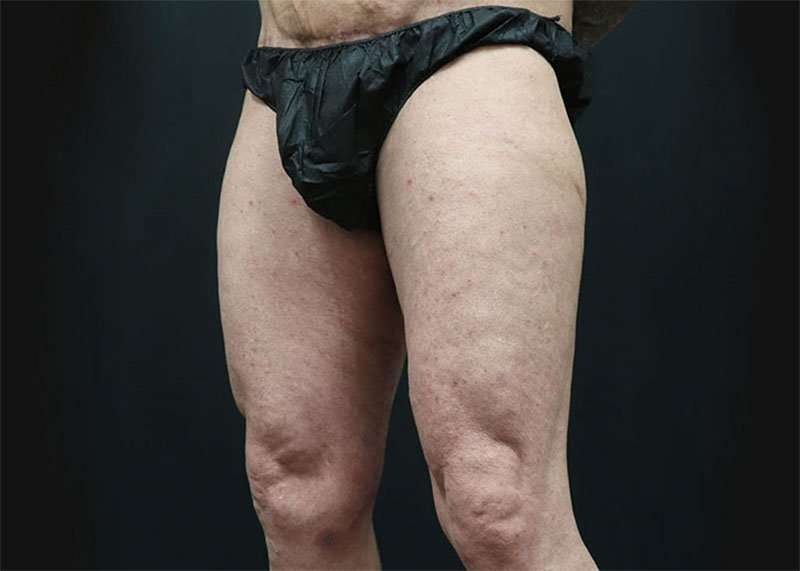 Thigh Lift Before & After Patient #1776