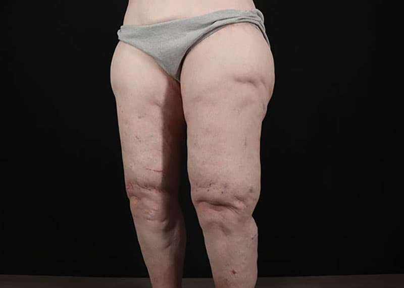 Thigh Lift Before & After Patient #1790
