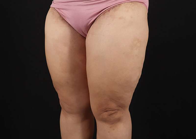 Thigh Lift Before & After Patient #1804