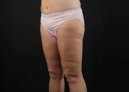Thigh Lift Before & After Patient #1818