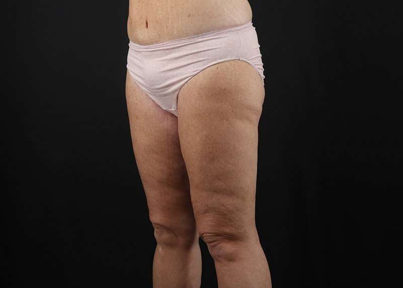 Thigh Lift Before & After Patient #1818