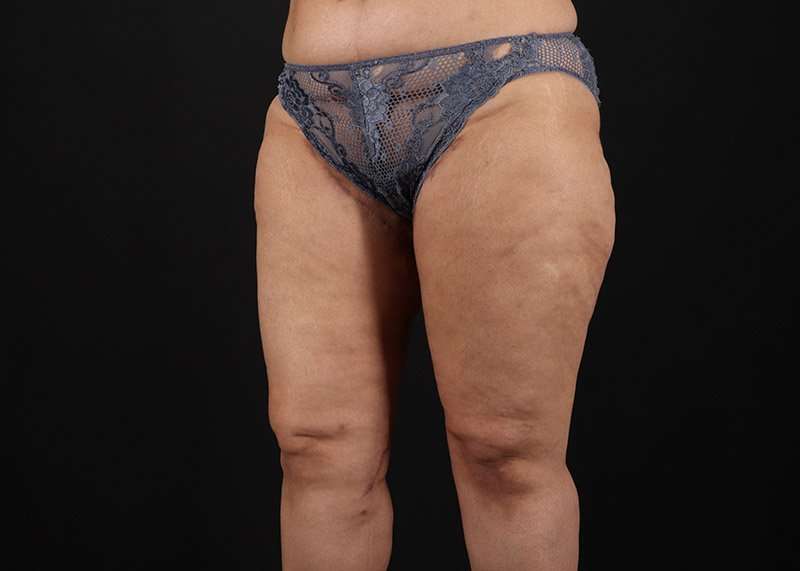 Thigh Lift Before & After Patient #1831