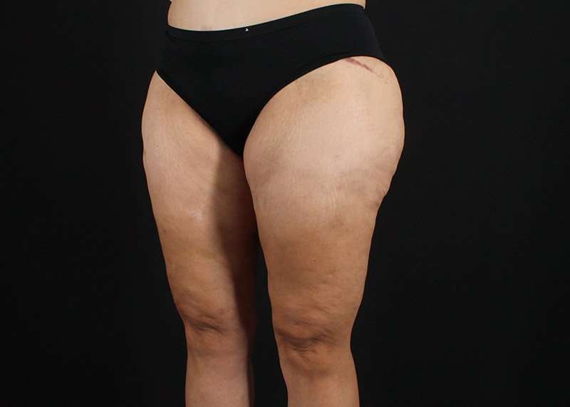 Thigh Lift Before & After Patient #1844