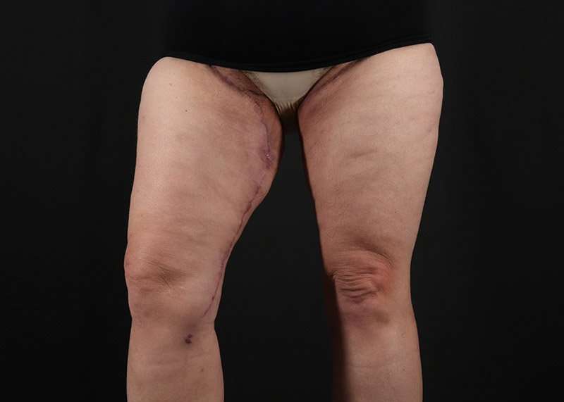 Thigh Lift Before & After Patient #1857