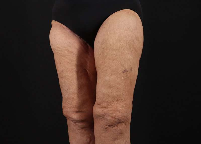Thigh Lift Before & After Patient #1871