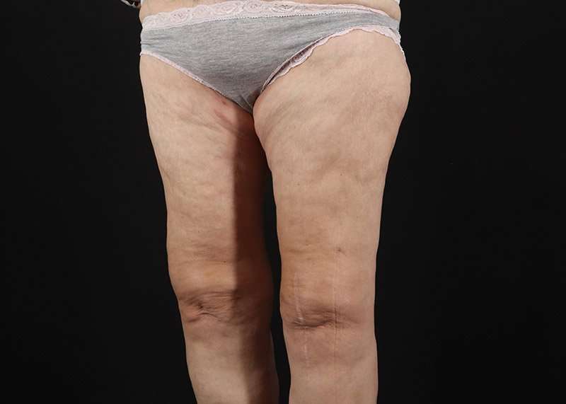Thigh Lift Before & After Patient #1884