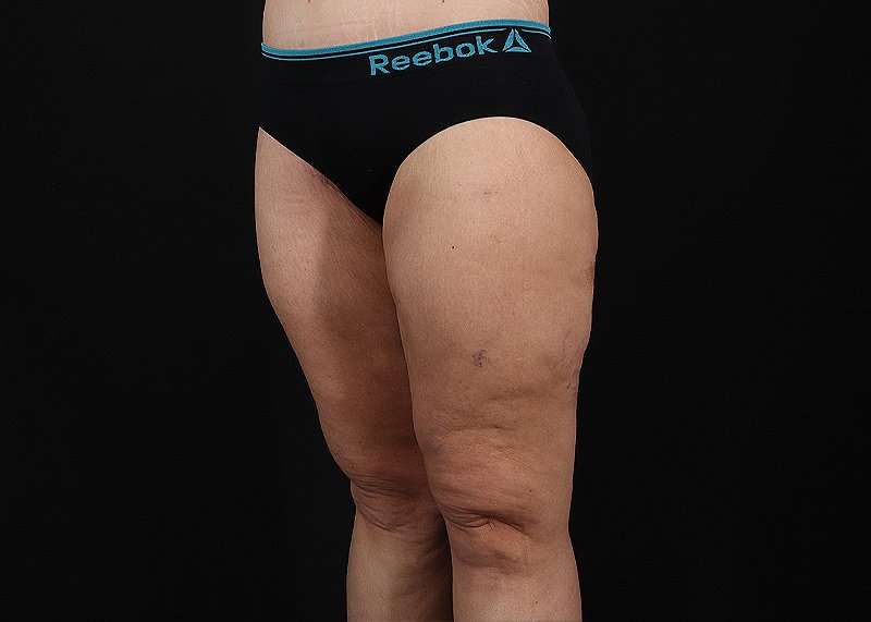 Thigh Lift Before & After Patient #1897