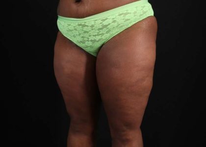 Thigh Lift Before & After Patient #1911