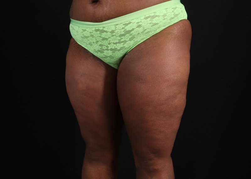 Thigh Lift Before & After Patient #1911