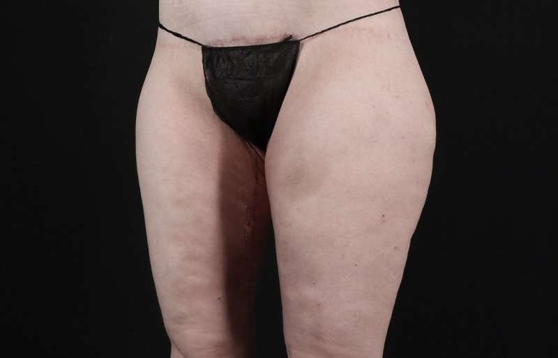Thigh Lift Before & After Patient #1925