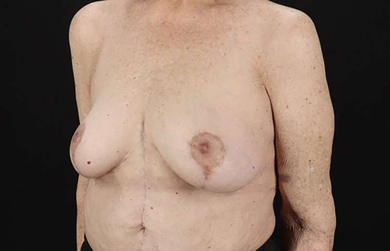 Breast Augmentation w/ Fat Transfer Before & After Patient #2049