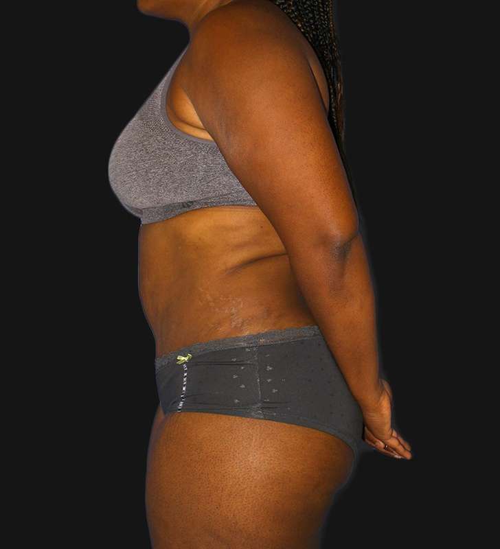 Abdominoplasty (Tummy Tuck) Before & After Patient #568