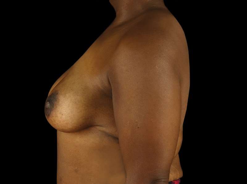 Breast Augmentation Before & After Patient #2121