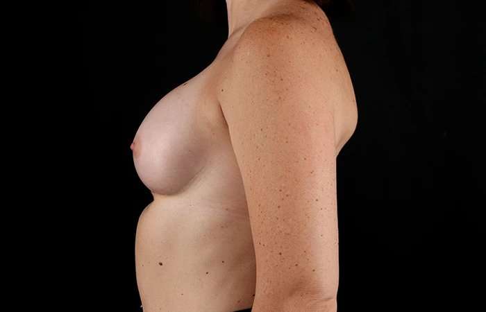 Breast Augmentation Before & After Patient #2365