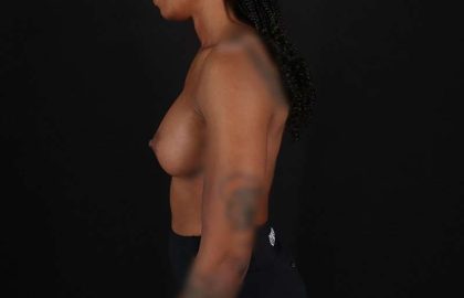 Breast Augmentation Before & After Patient #2376