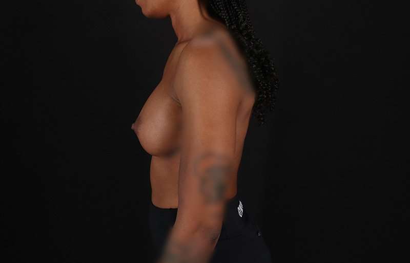 Breast Augmentation Before & After Patient #2376