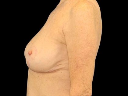 Breast Reduction Before & After Patient #2474