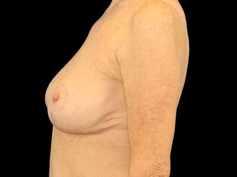 Breast Reduction Before & After Patient #2474