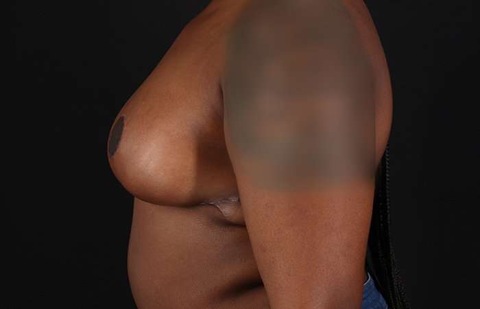 Breast Reduction Before & After Patient #2487