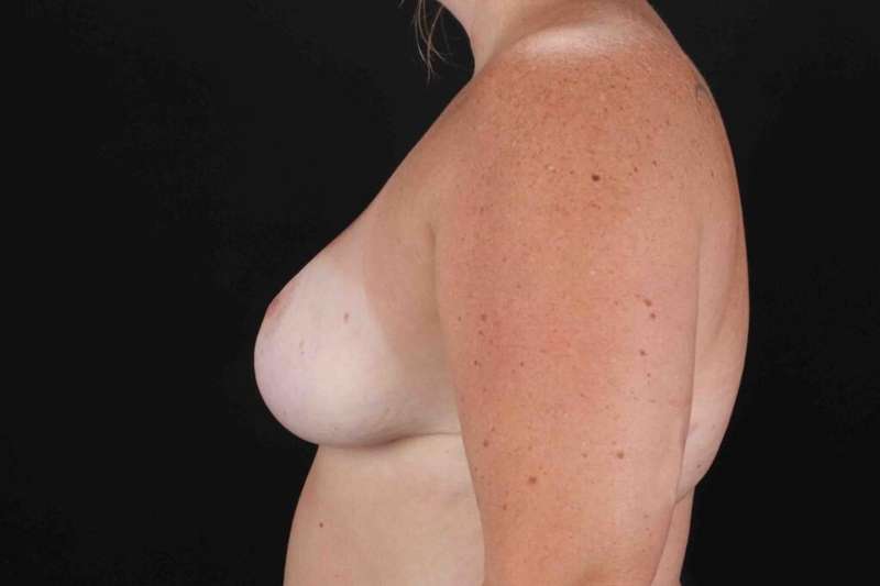 Breast Reduction Before & After Patient #2558