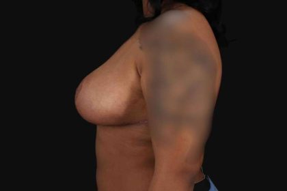 Breast Reduction Before & After Patient #2602