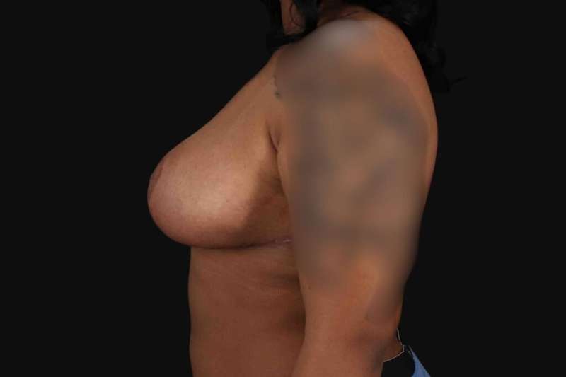 Breast Reduction Before & After Patient #2602