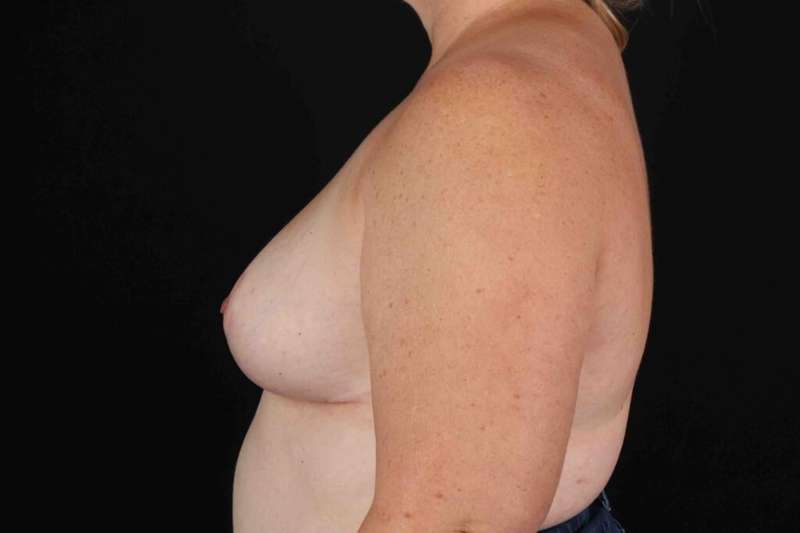 Breast Reduction Before & After Patient #2613