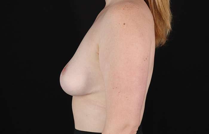 Breast Reduction Before & After Patient #2624