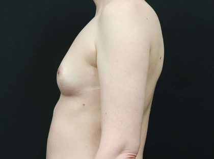 Breast Reduction Before & After Patient #2635