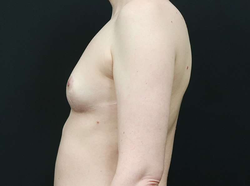 Breast Reduction Before & After Patient #2635