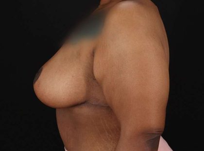 Breast Reduction Before & After Patient #2646