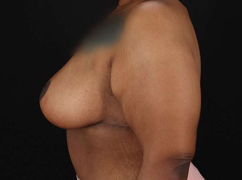 Breast Reduction Before & After Patient #2646