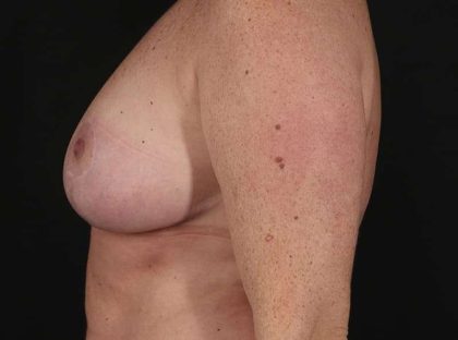 Breast Reduction Before & After Patient #2675