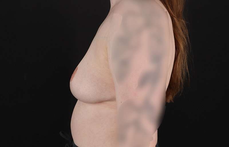 Breast Reduction Before & After Patient #2687